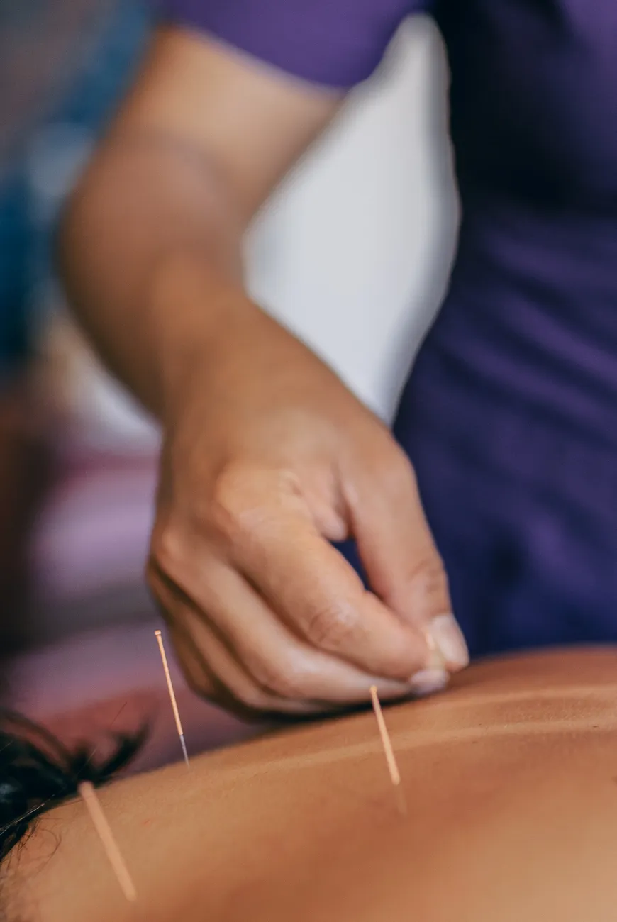 Aplicación de acupuntura específica sobre la espalda para aliviar tensiones y armonizar el cuerpo