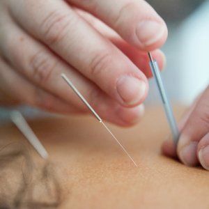 Terapia de Acupuntura Específica