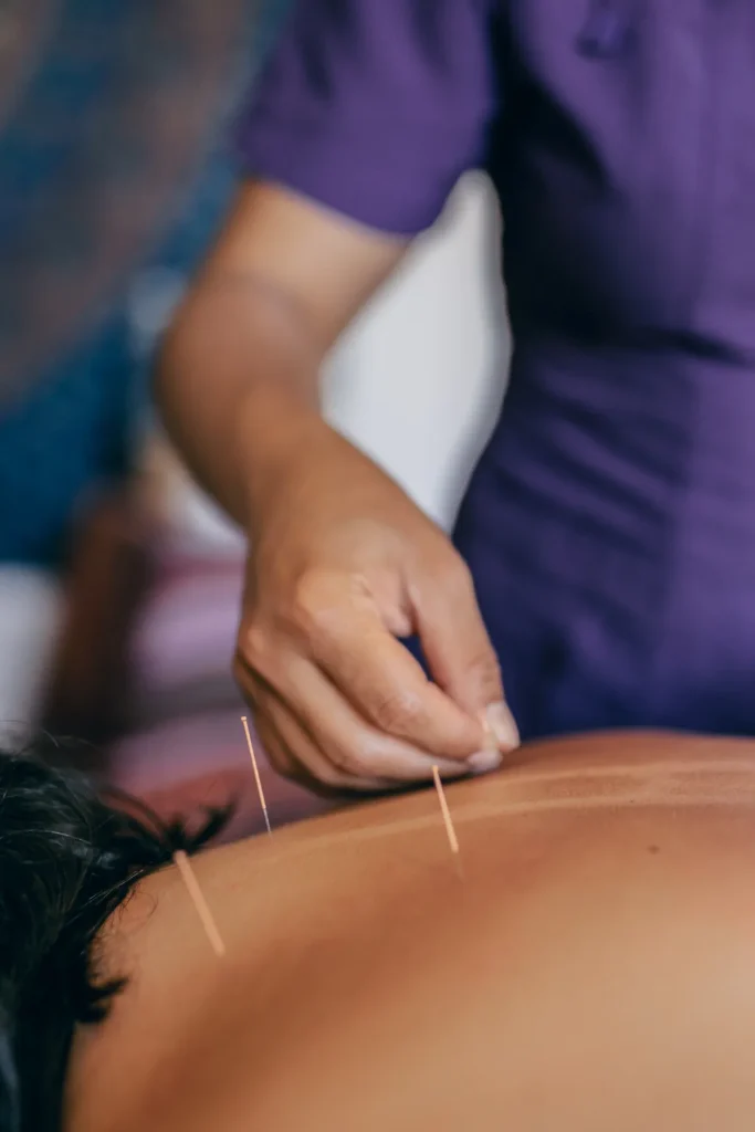 Susana aplicando acupuntura terapéutica para aliviar dolor y equilibrar la energía corporal